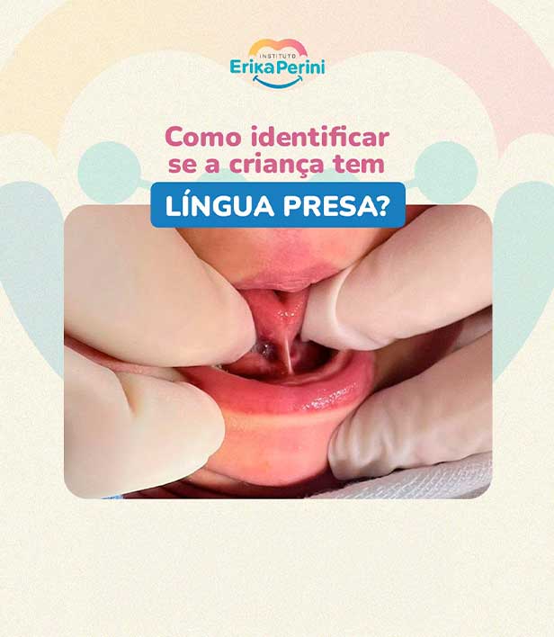 Como saber se o bebê tem lingua presa